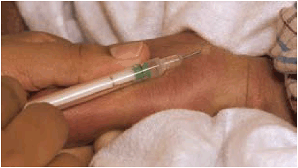 Figure 3.3. Administering BCG injection
